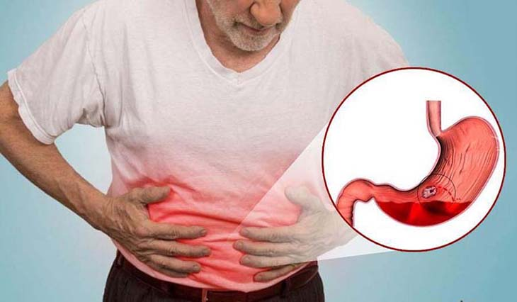 Dấu hiệu loét dạ dày – Nhận biết, nguyên nhân và cách điều trị hiệu quả