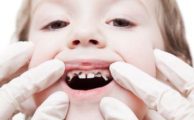 Phòng chống sâu răng ở trẻ em: Cách phát hiện và điều trị khi ăn vào tủy tối ưu hiệu quả