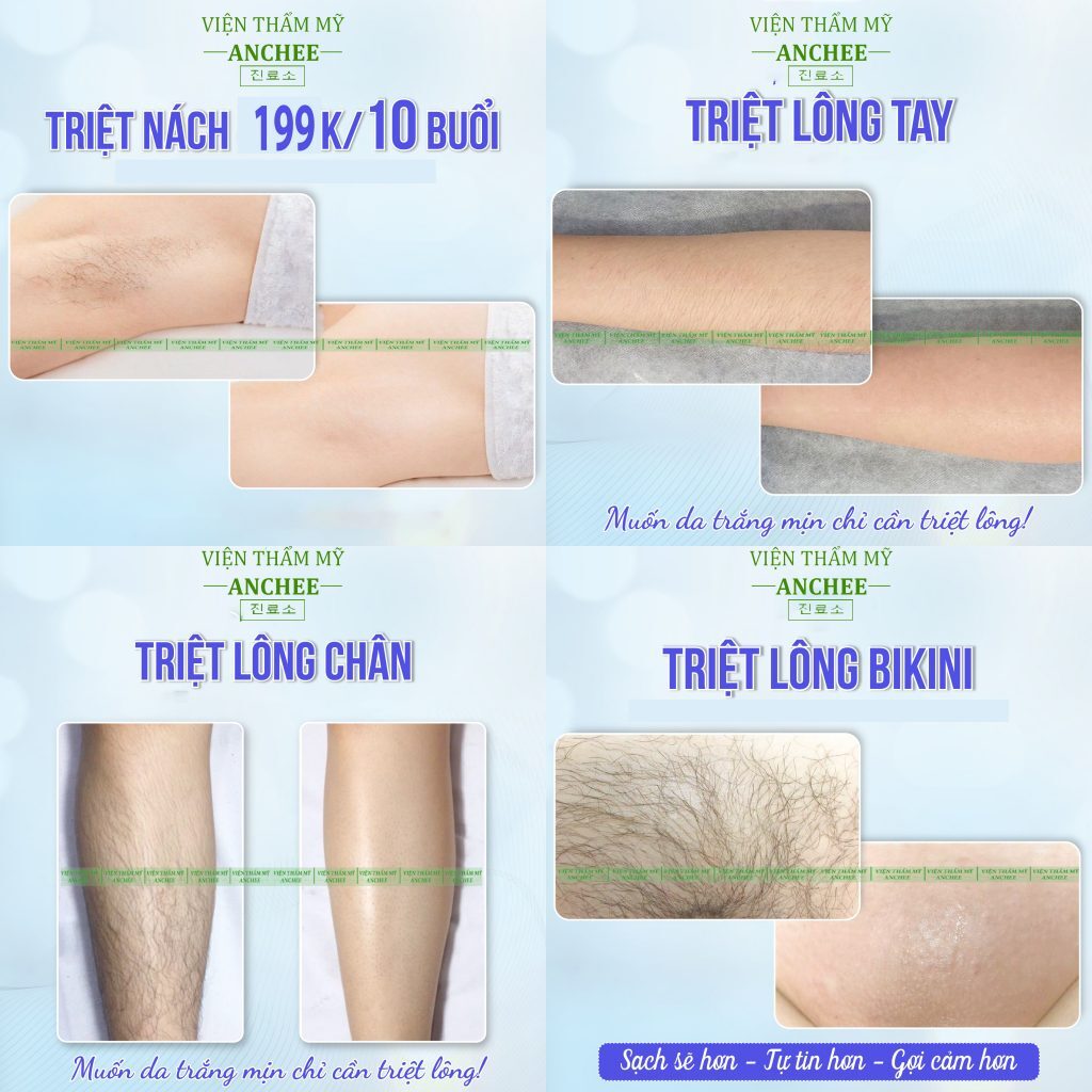 Triệt lông bikini – Giải pháp hoàn hảo cho vấn đề lông không mong muốn