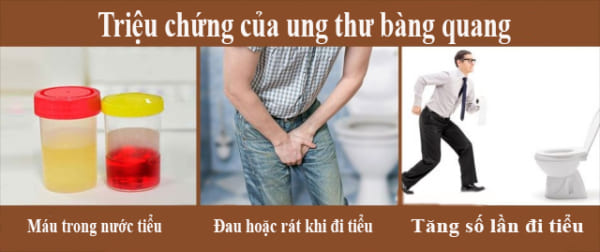 Tận tâm chăm sóc và điều trị ung thư bàng quang hiệu quả đến từ chuyên gia y tế hàng đầu