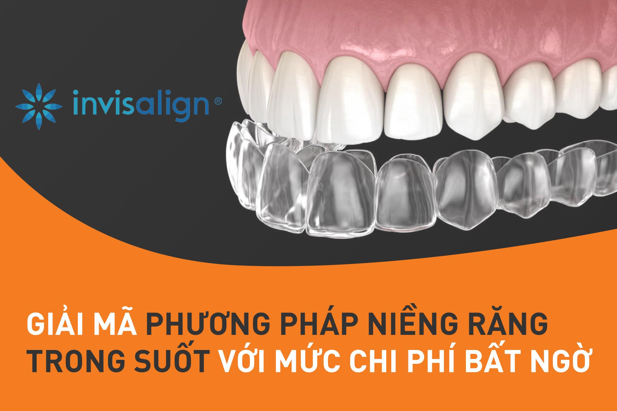 Giá niềng răng trong suốt – Giá, thông tin, các loại và cách chăm sóc hiệu quả