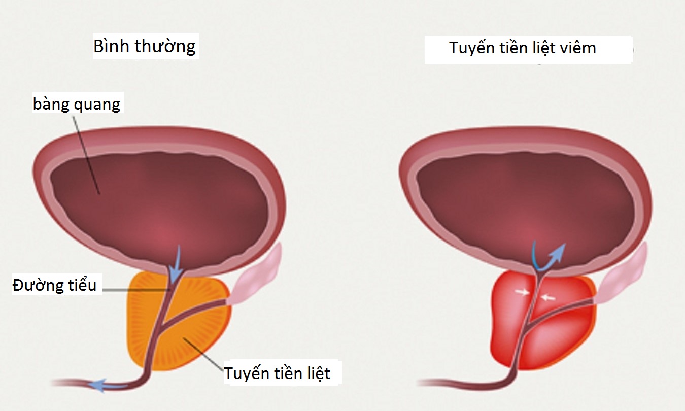 Điều trị hiệu quả viêm tuyến tiền liệt với những phương pháp mới nhất