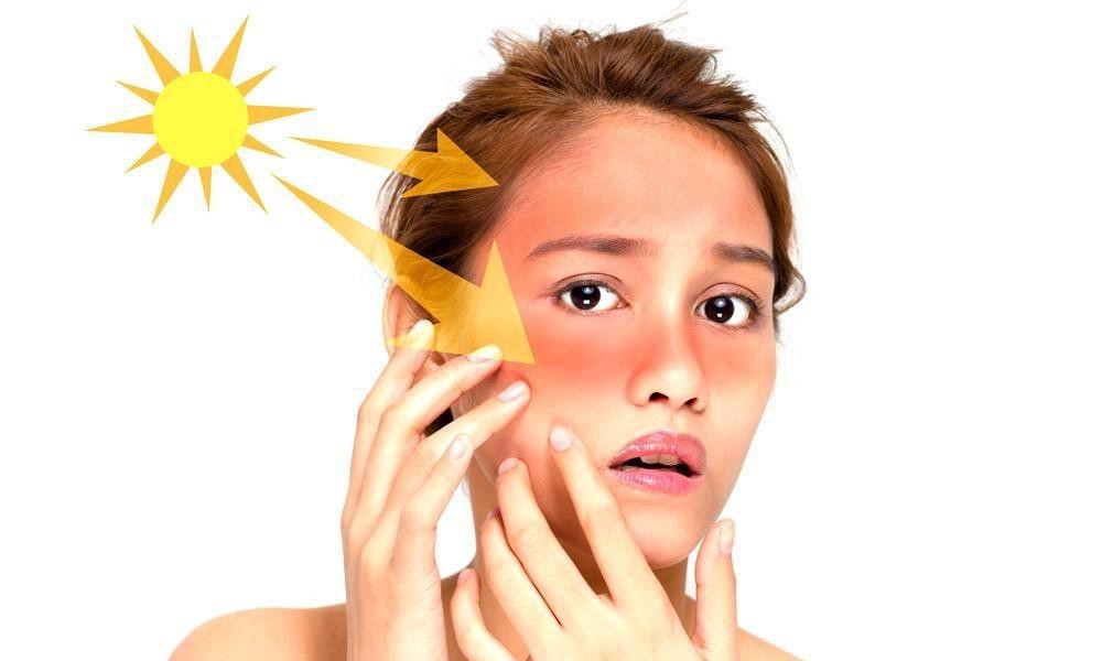 Ánh sáng mặt trời là kẻ thù của làn da