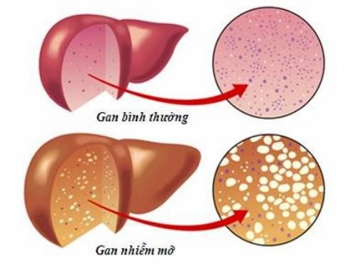 Gan nhiễm mỡ là gì? Nguyên nhân gây ra bệnh gan nhiễm mỡ