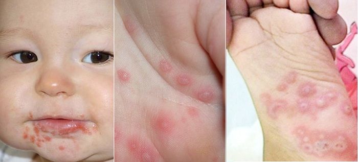 Bệnh tay chân miệng ở trẻ em: Nguyên nhân, triệu chứng và cách phòng tránh hiệu quả