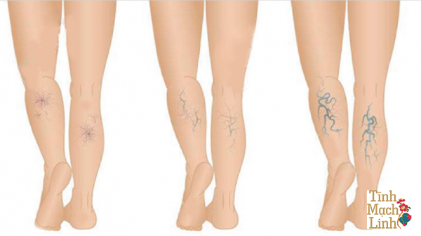 Suy giãn tĩnh mạch chân: Nguyên nhân, triệu chứng và cách điều trị hiệu quả