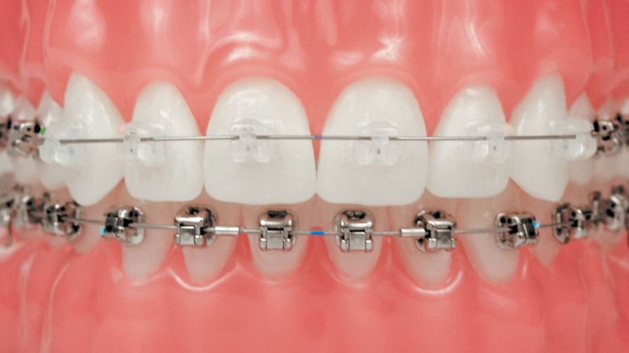 Giá niềng răng cho người lớn: Thông tin chi tiết và chi phí niềng răng hiệu quả