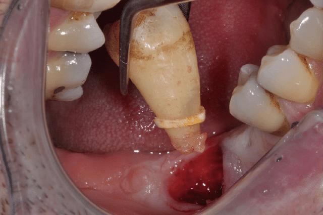 Phương pháp điều trị răng số 7 bị sâu vỡ hiệu quả và bền vững