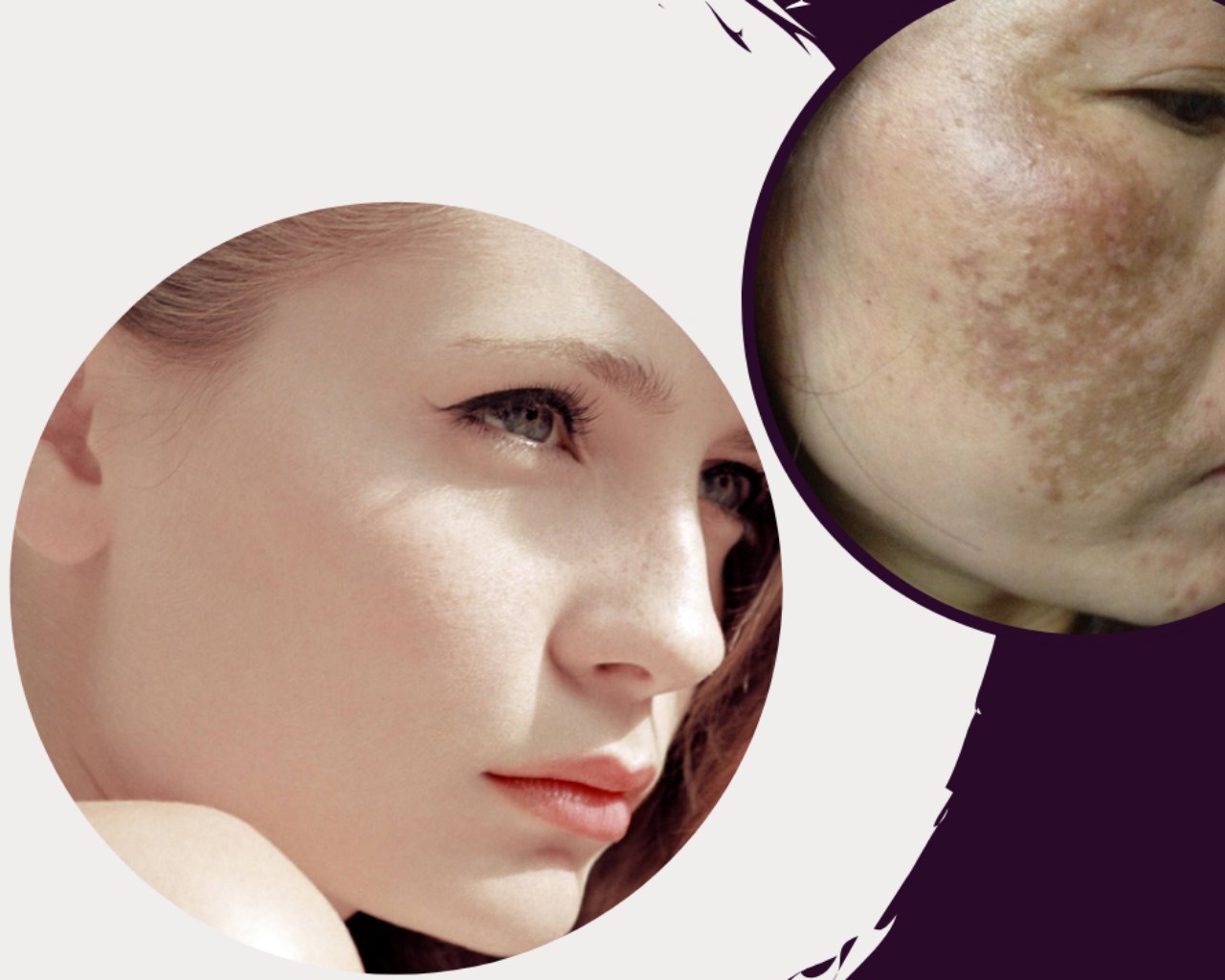 Cách trị tàn nhang hiệu quả và an toàn cho da: Những bí quyết từ thiên nhiên