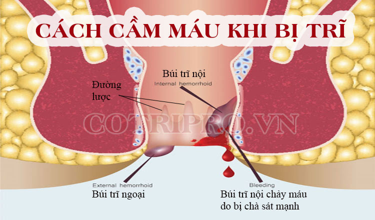 Cẩm máu nhanh: Những phương pháp đơn giản và hiệu quả để kiểm soát tình trạng chảy máu 2