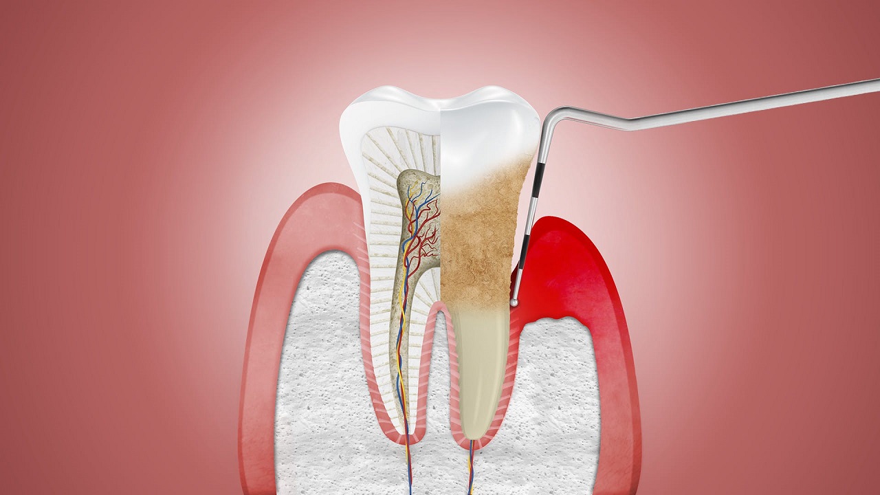 Cách chữa viêm nha chu răng hiệu quả tại nhà - Tổng hợp những phương pháp đơn giản và an toàn
