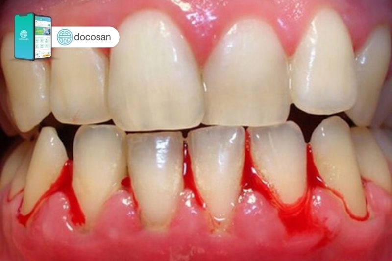 Cách chữa viêm nha chu răng hiệu quả tại nhà – Tổng hợp những phương pháp đơn giản và an toàn