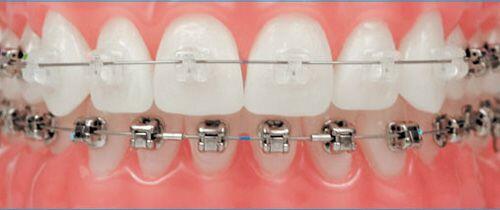 Cập nhật chi tiết chi phí niềng răng mắc cài kim loại 2021 - Tư vấn chuyên nghiệp từ các chuyên gia nha khoa