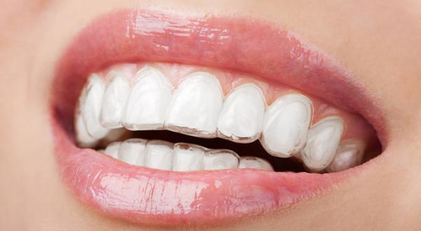 Giải pháp chữa răng hô nhẹ không cần niềng hiệu quả và tiết kiệm chi phí