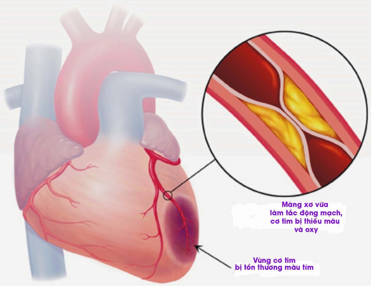 Nhồi máu cơ tim: Tìm hiểu nguyên nhân, triệu chứng và cách phòng tránh