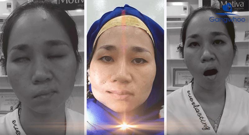 Liệt dây thần kinh số 7 - Tình trạng, nguyên nhân và phương pháp điều trị hiệu quả
