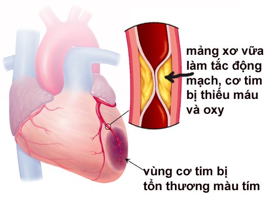 Nhồi máu cơ tim: Tìm hiểu nguyên nhân, triệu chứng và cách phòng tránh