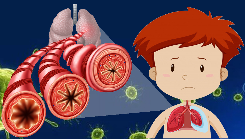 Phân biệt viêm phế quản và viêm phổi: Những khác biệt đáng lưu ý và cách phòng chống hiệu quả