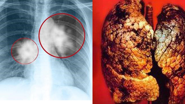 Dấu hiệu bị ung thư phổi: Những triệu chứng và cách phòng ngừa