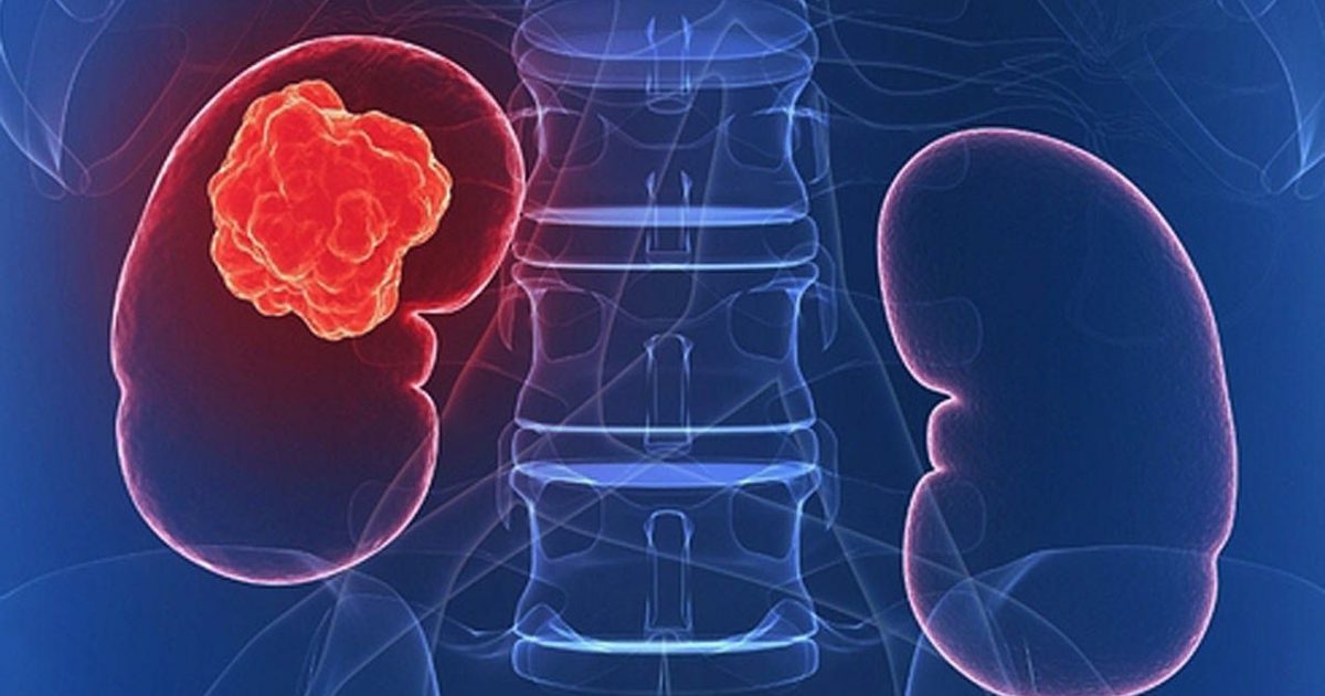 Giải pháp hiệu quả trong điều trị ung thư thận: Tìm hiểu về các phương pháp và công nghệ mới 2