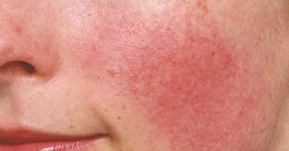 Vùng kín có cặn trắng và ngứa: Nguyên nhân và cách giải quyết chuyên nghiệp 2